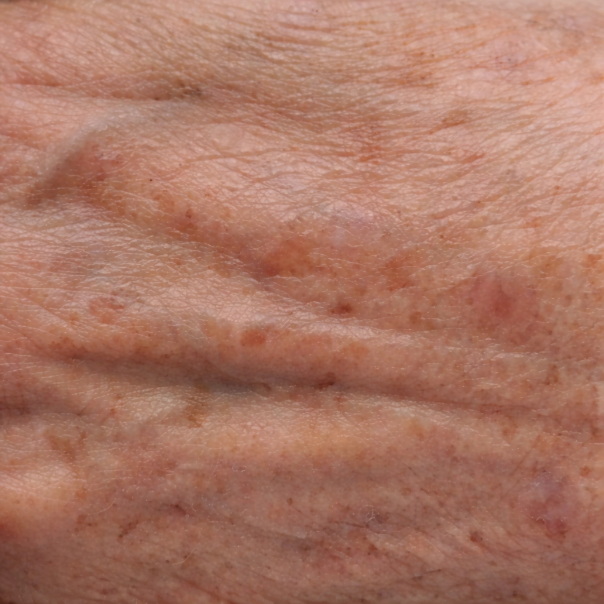 Stárnoucí kůže s pigmentovými skvrny 