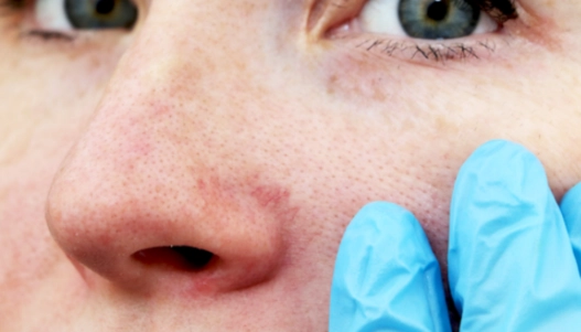 Kosmetička radí, jak na červené žilky a citlivou pleť